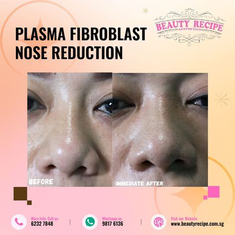 Plasma Fibroblast Nose Reduction Nose Reduction, Nose Lift, Plasma Fibroblast, Non Surgical Facelift, Excess Skin, Eye Lift, Beauty Recipe, Book Your Appointment, Surgery