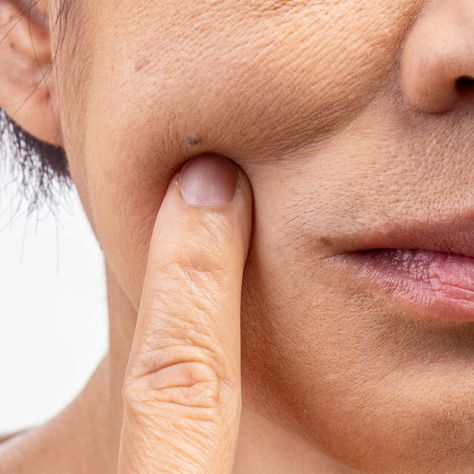 What Are Milia Spots? A Dermatologist Explains The Common Aging Skin Condition And How To Treat It - SHEfinds Lipstick Hacks, Makeup Tips For Older Women, Hair Elixir, Aging Beauty, Uneven Skin Texture, Dull Hair, Undereye Circles, Best Oils, Sagging Skin