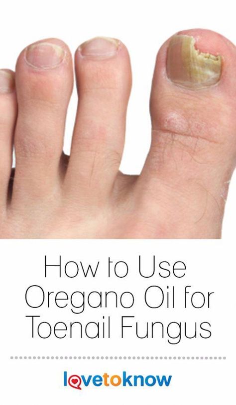 Oregano Oil Benefits, Natural Antifungal, Nails Feet, Fingernail Fungus, Toenail Fungus Remedies, Nail Fungus Remedy, Fungal Nail, Oregano Oil, Skin Nails