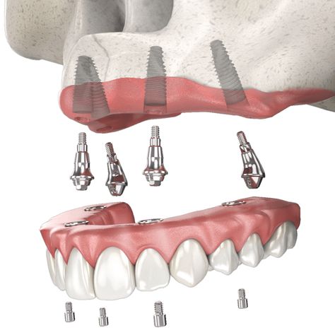 Implant supported dentures are a fantastic solution for individuals who have lost multiple teeth or require full-mouth tooth replacement. These dentures are designed to be more stable and secure than traditional removable dentures, as they are anchored into the jawbone using dental implants.

Dupont☎️ (260) 490-2013
Jefferson☎️ (260) 459-2860
Columbia City☎️ (260) 245-3161
#DrLuga #FortWayne #OralSurgeon #TheImplantDoctor #ImplantSupportedDentures Dental Images, Dental Implant Procedure, Denture Implants, Oral Maxillofacial, Jaw Surgery, Dental Implants Cost, Dental Fun, Columbia City, Oral Surgeon