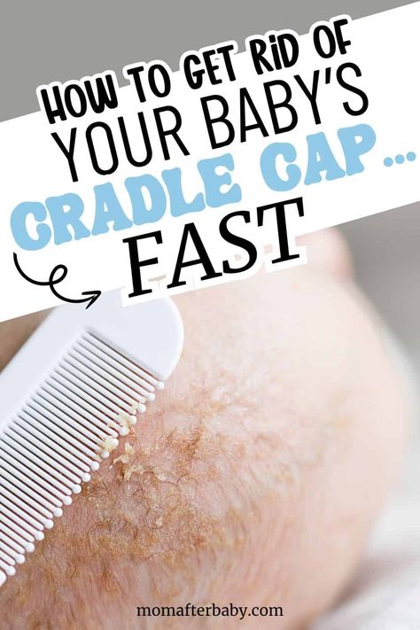 Best Remedies to Get Rid of Cradle Cap How To Get Rid Of Cradle Cap, Baby Dry Scalp, Toddler Cradle Cap, Cradle Cap Remedies, Baby Cradle Cap, Newborn Stuff, Dry Scaly Skin, Baby Sleep Routine, Cradle Cap