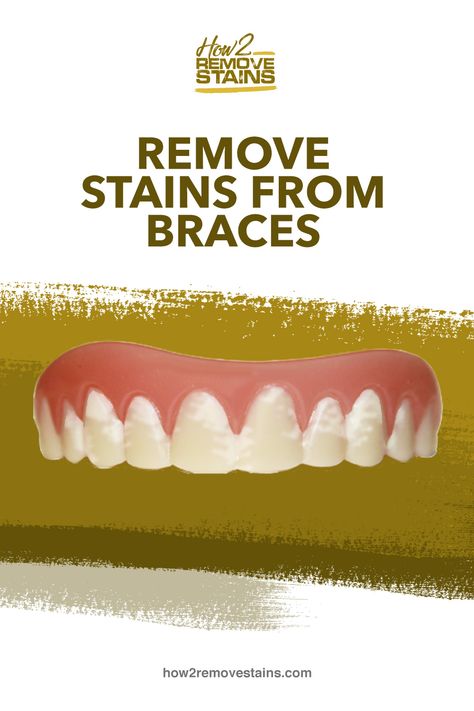 How to Remove Stains from Braces  [ Detailed Answer ]    Visit How2RemoveStains.com Braces Stains, Braces Removal, Teeth After Braces, Braces Rubber Bands, After Braces, Teeth Stain Remover, Braces Bands, Ceramic Braces, Getting Braces