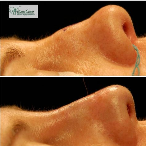 It's amazing how Dr. Williams can make small changes to the nose that make such a big impact on the way people feel about themselves. This real patient had an endonasal rhinoplasty to correct a mild saddle deformity. Rhinoplasty - Saddle Deformity: http://tinyurl.com/jybx4co #WilliamsCenter #DrEdwinWilliams #EndonasalRhinoplasty #nosejob #Rhinoplasty #NaturalResults #RhinoplastySpecialist Plastic Surgery Procedures, Albany Ny, Nose Job, Small Changes, The Nose, Plastic Surgery, Surgery, Saddle