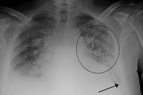 Machine learning tool scans lung X-rays to predict heart failure Cardiac Ischemia, Chest Tightness, Signs Of Alzheimer's, Angina Pectoris, Difficulty Breathing, Pulmonology, Blue Lips, Lung Disease, Phd Student