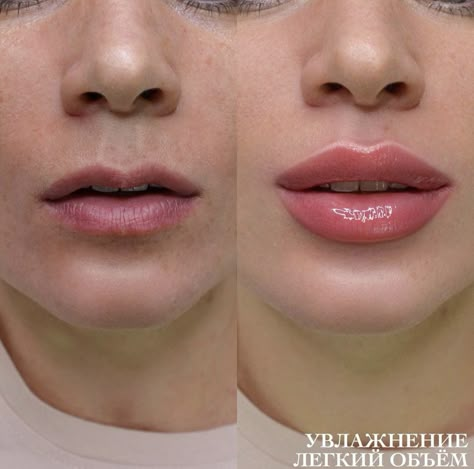 M Shaped Lips Before And After, Lip Fuller Shapes, M Shape Lip Filler, Small Mouth Lip Fillers, Lip Filler Shape Ideas Russian, Lip Filler Inspiration Natural, Desired Lips, Get Fuller Lips Naturally, Face Plastic Surgery