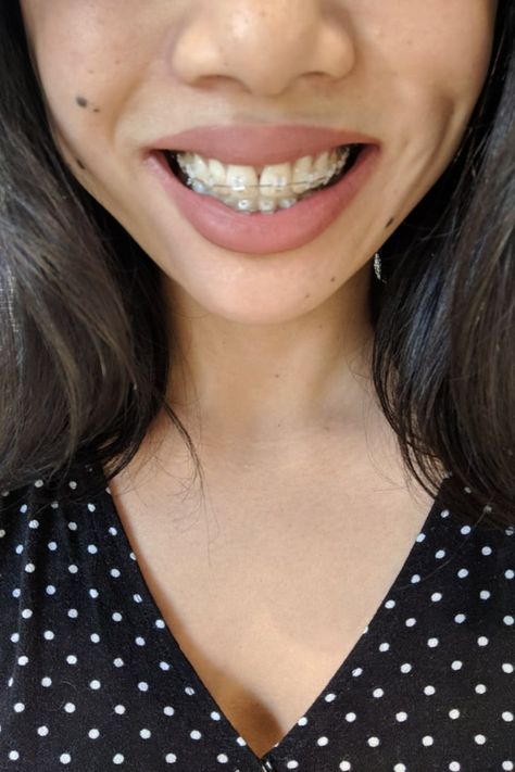 Should I Get Adult Braces? Braces Journey, Jewelry Teeth, Braces Colors Ideas, Teeth Gems, Braces Cost, Esthetic Dentistry, Waterpik Water Flosser, Adult Braces, Holistic Dentistry