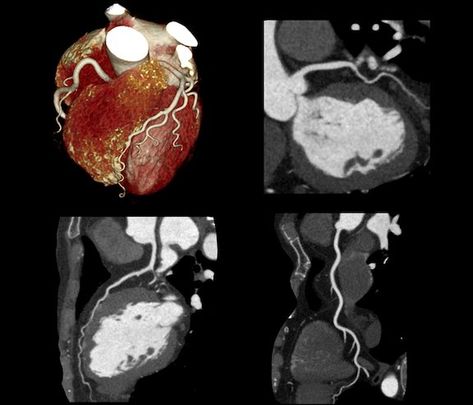 Nuclear Medicine, Coronary Arteries, Primary Care Physician, Chest Pain, Cardiology, Clinical Trials, Healthcare System, Improve Health, Medical Professionals