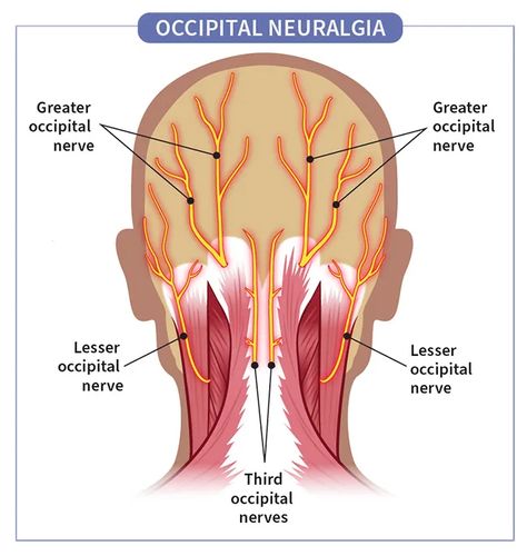 Occipital Neuralgia: Symptoms, Causes, Diagnosis, Treatments, and More Vestibular Migraines Symptoms, Occipital Neuralgia Symptoms, Occipital Neuralgia Relief, Cervical Instability, Autoimmune Disease Symptoms, Occipital Neuralgia, Migraine Pain, Facial Nerve, Head Pain