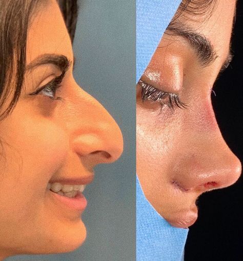 Dr. Ali Evlice IG : @ dralievlice Dream Nose, Nose Plastic Surgery, Nose Surgery Rhinoplasty, Plastic Surgery Fail, Rhinoplasty Nose Jobs, Face Surgery, Plastic Surgery Gone Wrong, Dr Ali, Big Nose Beauty