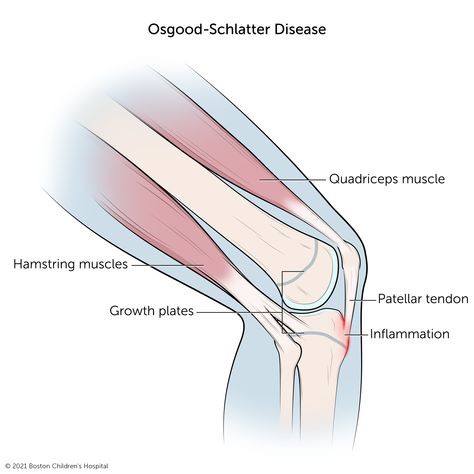 Osgood-Schlatter Disease | Boston Children's Hospital Osgood Schlatter Disease, Sports Injury Prevention, Boston Childrens Hospital, Swollen Knee, Tight Hamstrings, Bone Diseases, Lower Extremity, Magnetic Resonance Imaging, Activities For Teens