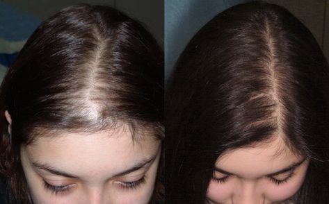 A common problem that suffer both men and women is hair loss. hair transplantation is right way for them to get rid of. Hair Transplant Women, Hair Fall Problem, Hair Transplant Results, Fue Hair Transplant, Hair Transplant Surgery, Best Hair Transplant, Baby Shawer, Hair Control, Hair Transplant