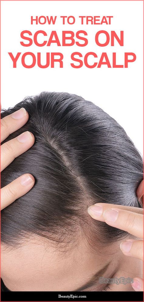 How to Get Rid of Scabs on Scalp – What it is, Causes and How to Treat Scabs On Scalp, Scalp Scabs, Scaly Scalp, Itchy Scalp Remedy, Pimples On Scalp, How To Remove Dandruff, Dry Scalp Remedy, Sores On Scalp, Scalp Acne