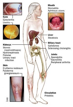 Gastrointestinal Healing, Chrones Disease, Crohns Symptoms, Chrons Disease, Invisible Disease, Gastrointestinal Disorders, Disease Symptoms, Large Intestine, Autoimmune Disorder