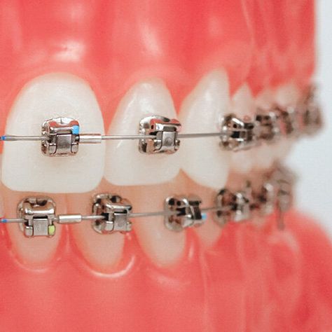 We all want everything faster. You may have heard that Damon braces can straighten your teeth faster, with fewer appointments, and without extractions or expanders. What is the Damon System and is it better than regular braces? #DrJBlog #Jorgensen😃 #JorgensenOrtho #Braces #Invisalign #Smile #Orthodontics #Ortho #Damon #SelfLigating #Brackets Brackets Aesthetic, Damon Braces, Braces Colors Ideas, Braces Cost, Types Of Braces, Misaligned Teeth, Orthodontic Appliances, Invisible Braces, Traditional Braces