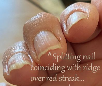 Splitting Fingernails, Fingernail Ridges, Nail Tips Designs, Fingernail Health, Nail Ridges, Grow Long Nails, Nail Remedies, Split Nails, Nail Growth Tips