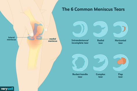 Meniscus Surgery Recovery, Knee Meniscus, Meniscus Surgery, Knee Surgery Recovery, Interesting Health Facts, Meniscal Tear, Knee Pain Relief Exercises, Knee Strengthening, Knee Ligaments