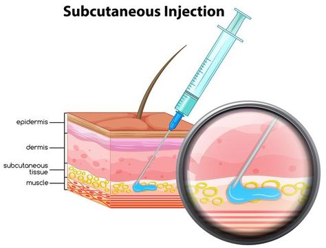 Subcutaneous Injection, Medical Health Care, Subcutaneous Tissue, Newborn Feeding, Disease Prevention, Test Tube, Kids Health, Nursing Students, Displaying Collections