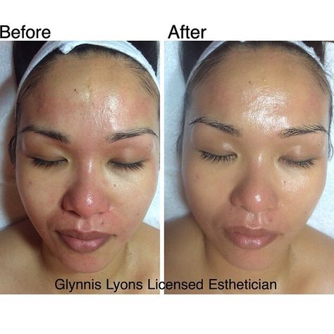 Before and after MicroPeel, Microdermabrasion and peel find out more about my esthetics work and details on my work instagram @glynnis_lyons Esthetician Before And After, Esthetician Marketing, Portfolio Project, Peeling Skin, Beautiful One, All Things Beauty, Esthetician, Portfolio, Marketing