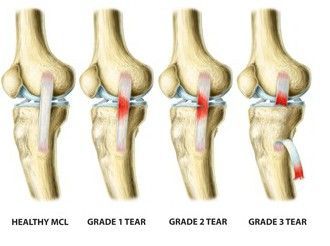 Mcl Tear, Knee Injury Recovery, Common Knee Injuries, Mcl Injury, Knee Surgery Recovery, Knee Ligaments, Anterior Cruciate Ligament, Knee Pain Exercises, Ligament Tear