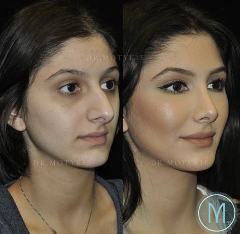 Before After Rhinoplasty, Nose Plastic Surgery, Nose Surgery Rhinoplasty, Nose Fillers, Rhinoplasty Nose Jobs, Rhinoplasty Before And After, Rhinoplasty Surgery, Cheek Fillers, Pretty Nose