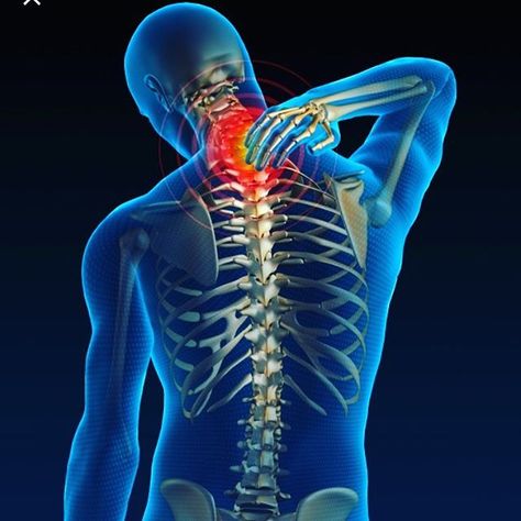 The vertebrae of the week is T3! This thoracic vertebrae affects the lungs bronchial tubes and chest. Symptoms could include congestion get T3 checked today! #hschan #highlightinghealth Stiff Neck Remedies, Cervical Spondylosis, Stiff Neck, Spine Surgery, Power Trip, Sciatic Nerve Pain, Neck Pain Relief, Sciatic Nerve, Physical Pain