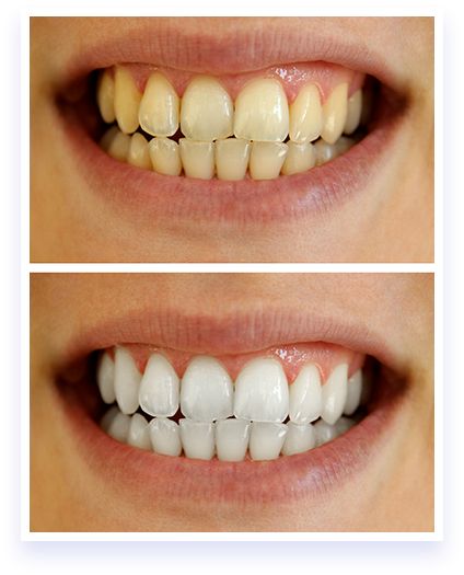 Teeth Whitening Methods, Teeth Whitening Remedies, Teeth Whitening Diy, Laser Teeth Whitening, Teeth Whitening System, Yellow Teeth, Nice Teeth, Best Teeth Whitening, White Smile