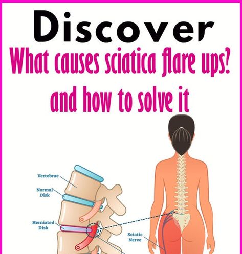 Overview Sciatica refers to pain that radiates along the path of the sciatic nerve, which branches from your lower back through your h... Sciatic Nerve Stretches, Back Pain Exercise, Abdominal Pain Relief, Sciatic Nerve Pain Relief, Sciatica Stretches, Sciatica Exercises, Sciatica Relief, Sciatica Pain Relief, Pinched Nerve