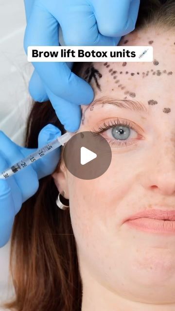 Dr Tim Pearce on Instagram: "Many of you ask how many Botox units I use for a subtle brow lift. Keep watching to find out. 

Only one week left until my free Botox webinar! If you’re feeling unsure about offering advanced treatments, this is the perfect opportunity to boost your confidence. Comment “TOX” for more info!" Brow Lift Botox Before And After, Brow Lift Botox Eyebrows, Botox For Hooded Eyelids, Eyebrow Lift Botox Before And After, Botox Brow Lift Before And After, Botox Units, Botox Eyebrow Lift, Botox Injection Sites, Botox Brow Lift