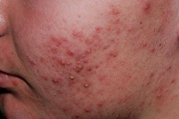 Acne Vulgaris - Acne vulgaris is a common human skin disease, characterized by areas of seborrhoea, comedones, papules, nodules, pimples and possible scarring. Face Cleaning Routine, Covering Acne, Acne Vulgaris, Types Of Acne, Sweat Gland, Acne Breakout, Scarring, Acne Remedies, Skin Diseases