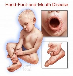 What are the best ways to treat a toddler who has hand-foot-and-mouth disease? Does she need to be seen by a doctor? Does having it once mean she will not get it again? Kids Vegetables, Nursing Diagnosis, Child Nutrition, Child Health, Gonna Be Alright, Infectious Diseases, Viral Infection, Childcare Center, Herbal Products