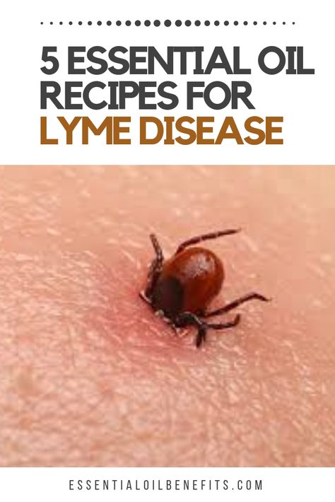 essential oils for lyme disease, essential oils for ticks, how to remove ticks with essential oils. Essential Oils For Tick Bites, Essential Oils For Lyme, Head Rap, Mindful Mom, Healing Flowers, Tick Removal, Deep Cleaning Hacks, Tick Bite, Cleaning Painted Walls