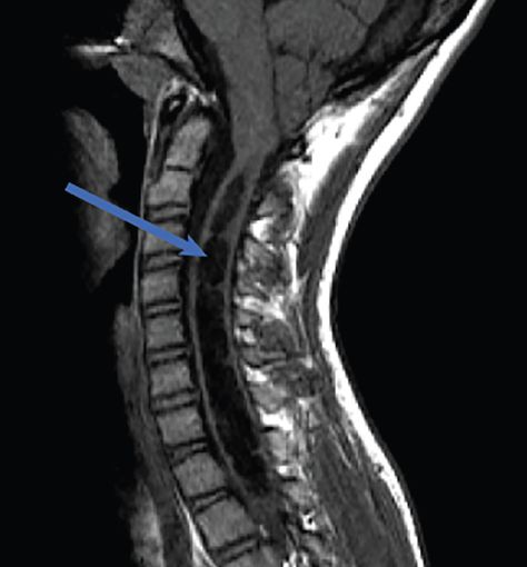 Understanding Chiari Malformation Comorbidities - Practical Neurology Spinal Cord Syndromes, Chiari Malformation Type 1, Medical Radiography, Chiari Malformation, Spinal Injury, Health And Happiness, Brain Fog, Neurology, Neck Pain