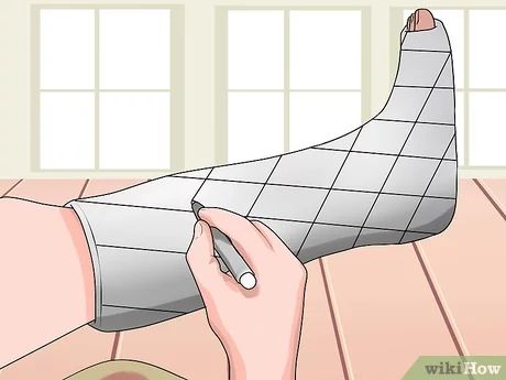 4 Ways to Have Fun With a Broken Leg - wikiHow Cast Ideas Leg, Cast Decorating Ideas Leg, Leg Cast Decorating Ideas, Crutch Decorations, Broken Ankle Cast, Broken Leg Cast, Ankle Cast, Cast Decoration, Broken Foot