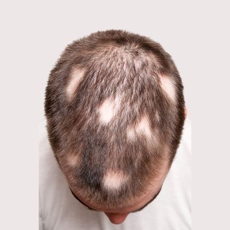 Scarring Alopecia, Alopecia Universalis, Androgenetic Alopecia, Pattern Baldness, Yes Or No, Hair Transplant, Hair Restoration, Hair Follicle, Facial Hair