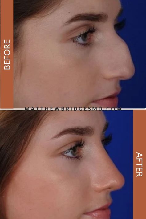 Dorsal Hump Rhinoplasty, Dorsal Hump Nose, Closed Rhinoplasty, Jaw Reduction Surgery, Nose Fillers, Hooked Nose, Plastic Surgery Fail, Parts Of The Nose, Nose Jobs