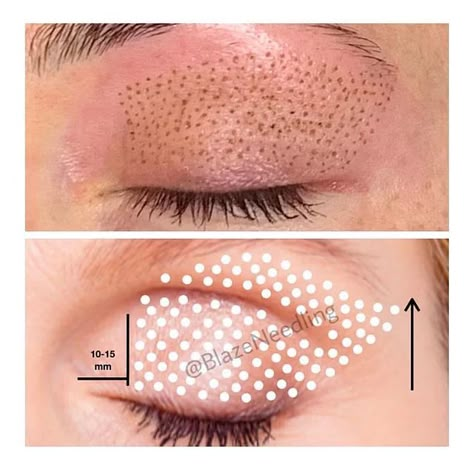 Plasma Pen Before After Under Eye, Plasma Facial, Skin Tightening Procedures, Chest Wrinkles, Plasma Pen, Scar Reduction, Skin Tightening Treatments, Fractional Laser, Lip Wrinkles