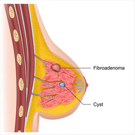 Breast cysts and fibroadenoma medical illustration. Credit: medicalstocks / Shutterstock Vegan Probiotics, Heart Diet, Breast Health, Types Of Cancers, Warning Signs, Lose Belly, New Orleans, Anatomy