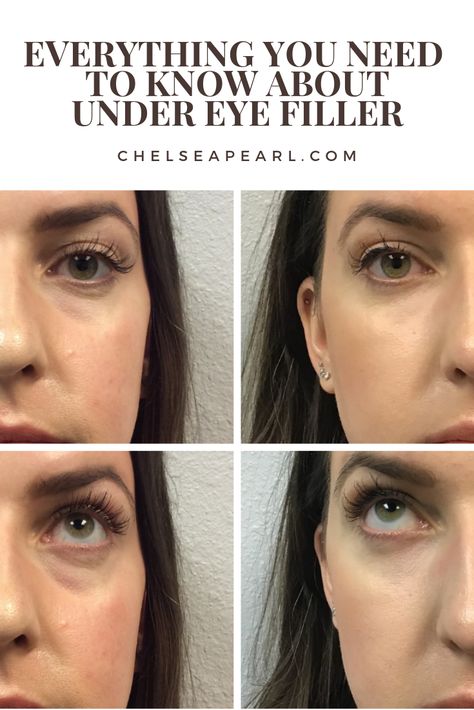 Let's talk under eye filler. I recently tried Restylane and Restylane Lyft so I wanted to answer the FAQs on cost, pain, & before and after photos. Under Eye Wrinkles Filler, Eye Wrinkles Before And After, Filler Under The Eyes, Before And After Fillers Faces, Eye Trough Filler, Xeomin Before And After, Facial Fillers Before And After Faces, Wrinkle Under Eyes, Trough Filler Before After