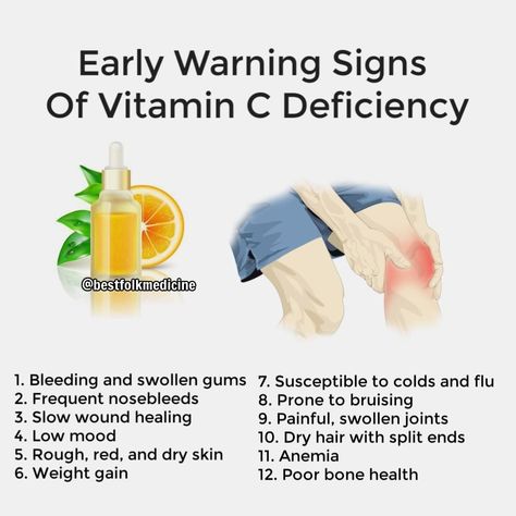 Best Folk Medicine on Instagram: “Follow @bestfolkmedicine for more Inspiring Holistic Health Posts! 🌱 🌱 🌱 Very common and delicious foods offer ample amounts and can be…” Vitamin C Deficiency Symptoms, Black Currents, Vitamin C Deficiency, Health Posts, Mineral Nutrition, Deficiency Symptoms, Swollen Gum, Natural Face Cleanser, Acerola Cherry