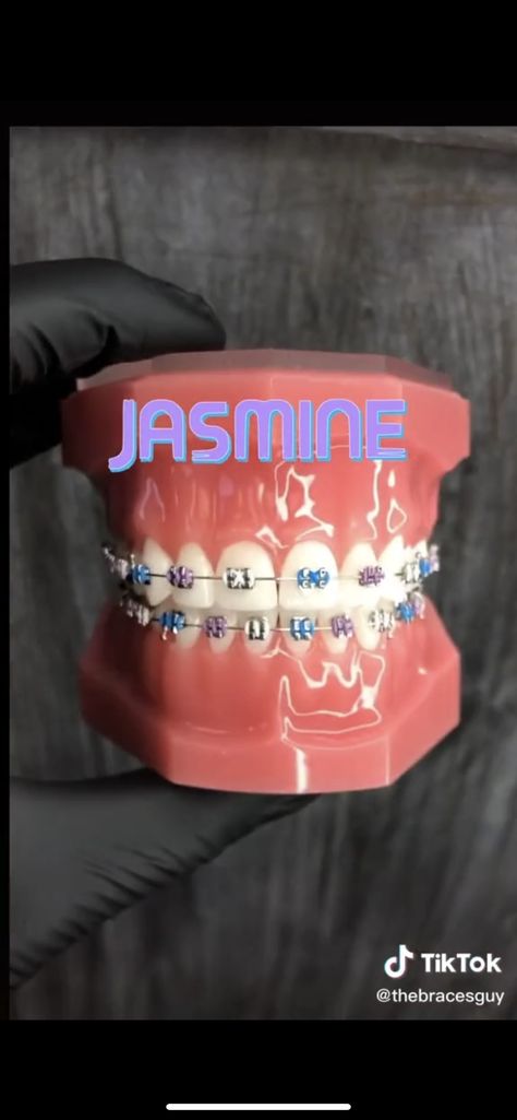 Brace Ideas, Braces Colours, Dental Braces Colors, Braces Colors Combinations, Braces Ideas, Green Braces, Braces Retainer, Braces Rubber Bands, Braces Bands