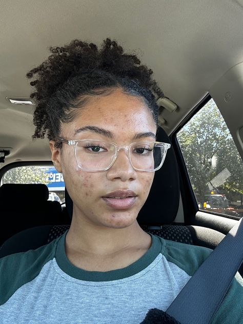 Acne Black Women, Acne Aesthetic, Acne Photos, Acne Women, Girl With Acne, Pimple Scars, Mild Acne, Big Nose Beauty, Beauty App