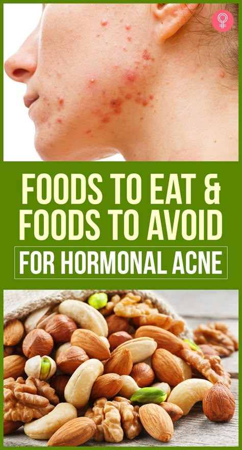 Foods To Eat And Foods To Avoid For Hormonal Acne: The changes could be something as simple as meditating for ten minutes daily to destress or something big like changing the fabrics you use or getting a good face wash. So in this article, we’re going to cover one such lifestyle change you can make- changing your diet. So here is a list of food items to eat and those to avoid. #hormonalacne #acne #beauty #beautytips Good Face Wash, Food For Acne, Acne Beauty, List Of Food, Acne Diet, Good Face, Foods For Healthy Skin, Skin Diet, Best Face Wash