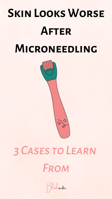 Are you ready to do everything to make your skin right after you have done everything to make your skin right because the former ruined it? That’s true. Microneedling can turn into your worst nightmare, and stories of people’s Skin Looks Worse After Microneedling are real. These people and many others swimming across the internet are now cursing this method. Let’s pick up the dos and don’ts! Microneedling Before And After, At Home Microneedling, What Is Microneedling, Microneedling Depth Chart, Microneedling After Care, Microneedling Radiofrequency, Skin Pen Microneedling, Microneedling Skinpen, After Microneedling