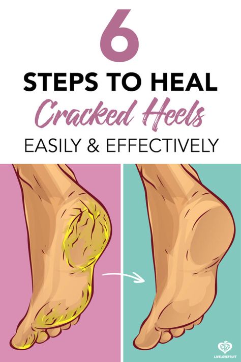 dry cracked heels before and after with text - 6 steps to heal cracked heels easily and effectively Homemade Foot Cream, Cracked Heel Remedies, Heal Cracked Heels, Dry Cracked Heels, Dry Heels, Dry Skin Remedies, Cracked Heels, Lifestyle Habits, Foot Cream