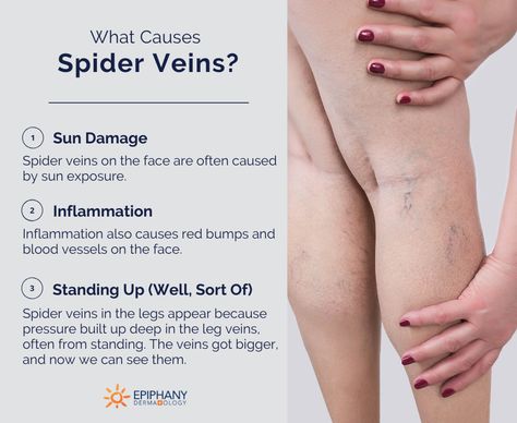 Spider Vein Remedies, Home Remedies For Spiders, Vein Health, Get Rid Of Spiders, Varicose Vein Remedy, Visible Veins, Leg Veins, Red Veins, Green Veins