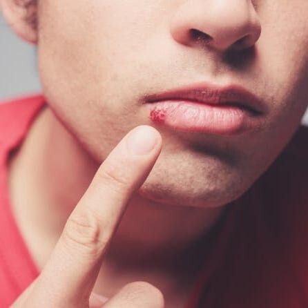 What causes a cold sore? The reason is not as taboo as some might think. — USA TODAY Pimples On Lip Line, Cracked Corners Of Mouth, Natural Cold Sore Remedy, Get Rid Of Cold, Fever Blister, Essential Oils For Colds, Cold Sores, Canker Sore, Cold Sores Remedies