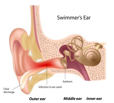 Get rid of an ear infection - 51 Extraordinary Everyday Uses for Hydrogen Peroxide Swimmers Ear Remedy, Blocked Ears, Cleaning With Peroxide, Swimmers Ear, Middle Ear, Wellness Mama, Diy Cleaning Hacks, Sinus Infection, Hydrogen Peroxide