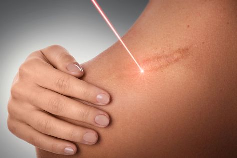 Burn Scar Removal, Laser Stretch Mark Removal, Laser Scar Removal, Tattoo Removal Cost, Scar Reduction, Laser Skin Resurfacing, Stretch Mark Removal, Severe Acne, Acne Scar Removal