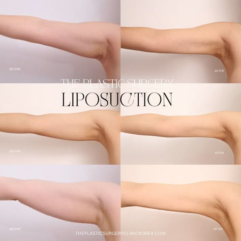 3 Months before after arm liposuction of THE Plastic Surgery Clinic's Patients Liposuction is a popular cosmetic surgery procedure that involves the removal of excess fat from different parts of the body. Choosing the right surgeon for this procedure is crucial to ensure success. Qualifications, Credentials, and Experience are the essential factors to consider.  #liposuctionkorea#liposuctionseoul#liposuctiongangnam#liposuctionapgujeong#liposuctionpyeongtaek#liposuctionpromotion#bodyplasticsurgerykorea Liposculpture Before And After, Lipo 360 Before And After, Medical Activities, Lipo Before And After, Plastic Surgery Clinic, Gangnam Seoul, Ads Inspiration, Seoul City, Face Yoga Facial Exercises