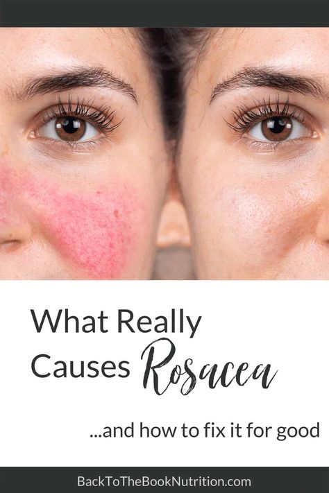 How To Stop Redness On Face Skin Care, Skin Care Reduce Redness, How To Help Redness On Face, How To Fix Redness On Face, Facial Redness Remedies, Get Rid Of Redness On Face, Rosatia Remedies, Face Redness Remedy, Red Face Remedies